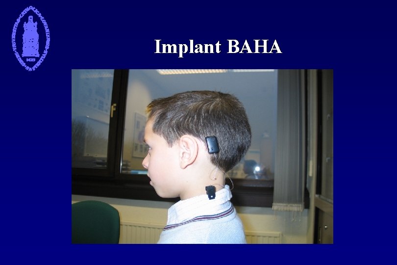 Implant BAHA 