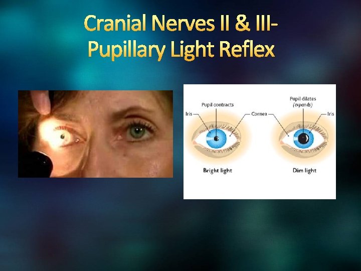 Cranial Nerves II & IIIPupillary Light Reflex 