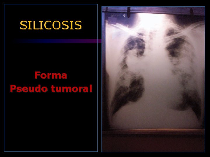 SILICOSIS Forma Pseudo tumoral 