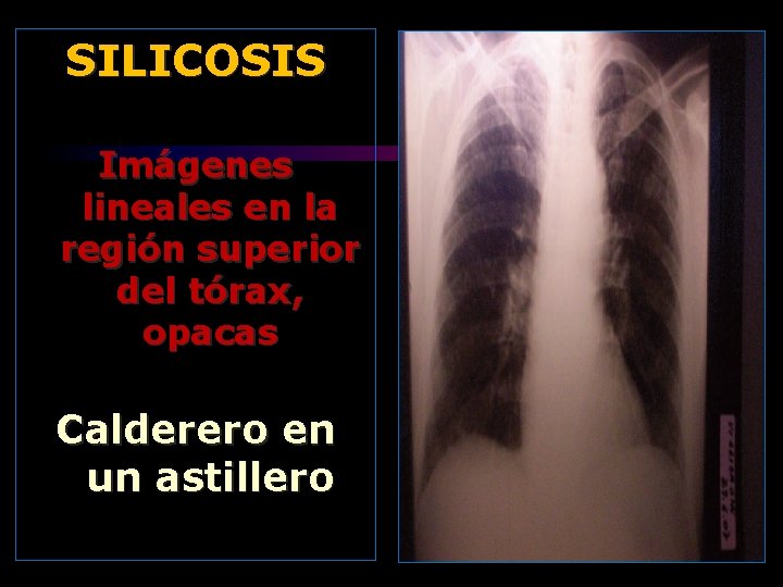 SILICOSIS Imágenes lineales en la región superior del tórax, opacas Calderero en un astillero