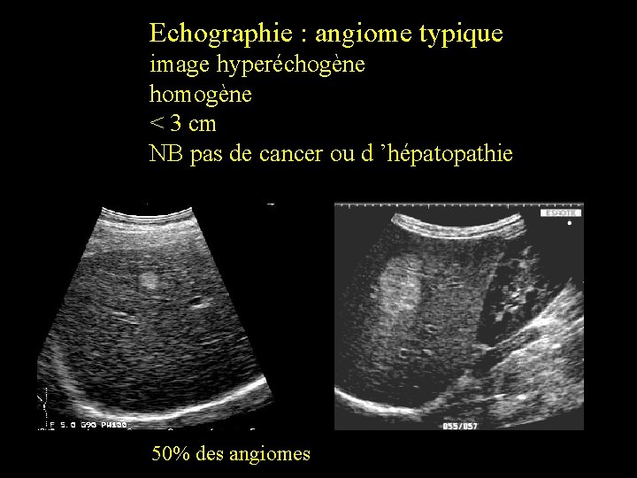 Echographie : angiome typique image hyperéchogène homogène < 3 cm NB pas de cancer