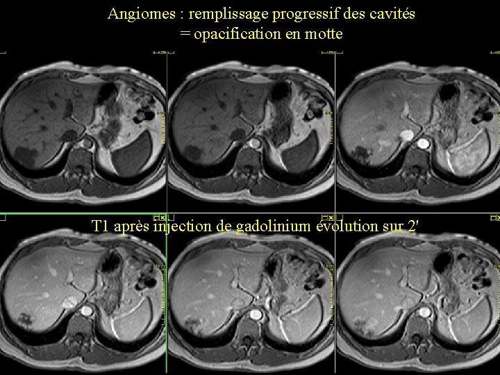 Angiomes : remplissage progressif des cavités = opacification en motte T 1 après injection