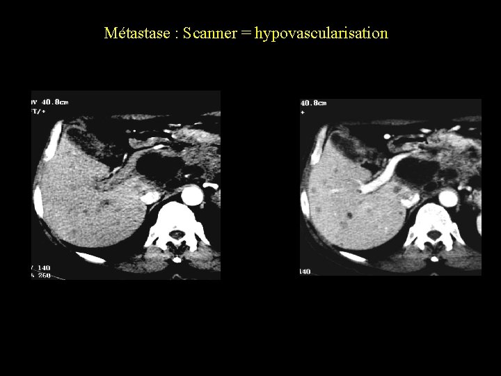Métastase : Scanner = hypovascularisation 