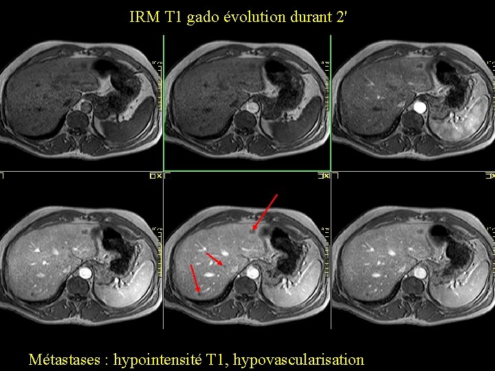 IRM T 1 gado évolution durant 2' Métastases : hypointensité T 1, hypovascularisation 