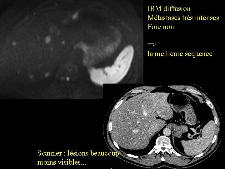 IRM diffusion Métastases très intenses Foie noir => la meilleure séquence Scanner : lésions