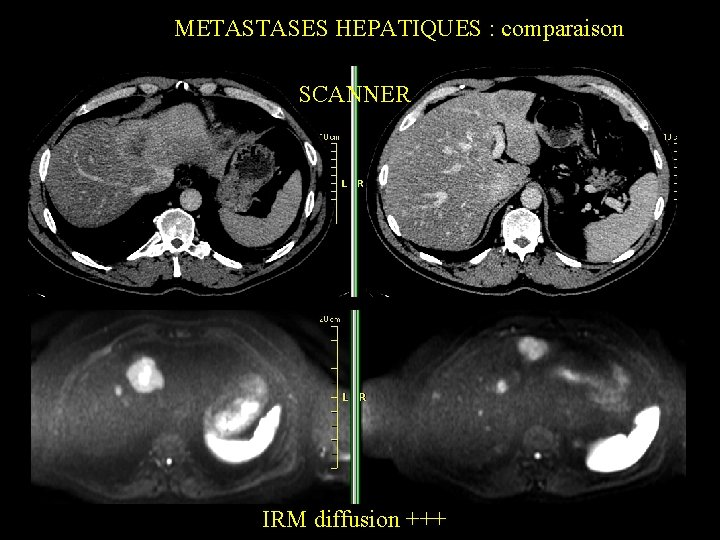 METASTASES HEPATIQUES : comparaison SCANNER IRM diffusion +++ 