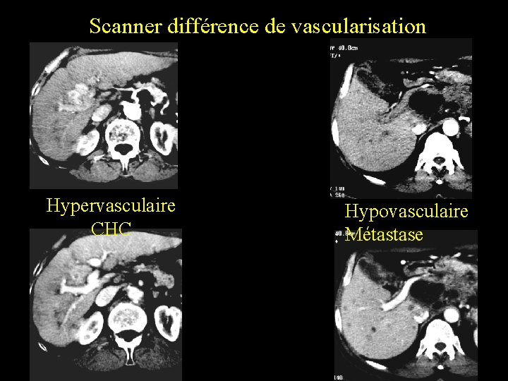 Scanner différence de vascularisation Hypervasculaire CHC Hypovasculaire Métastase 