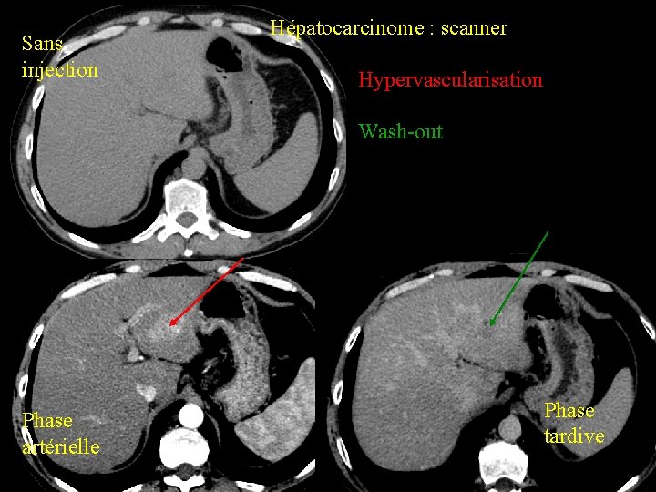 Sans injection Hépatocarcinome : scanner Hypervascularisation Wash-out Phase artérielle Phase tardive 