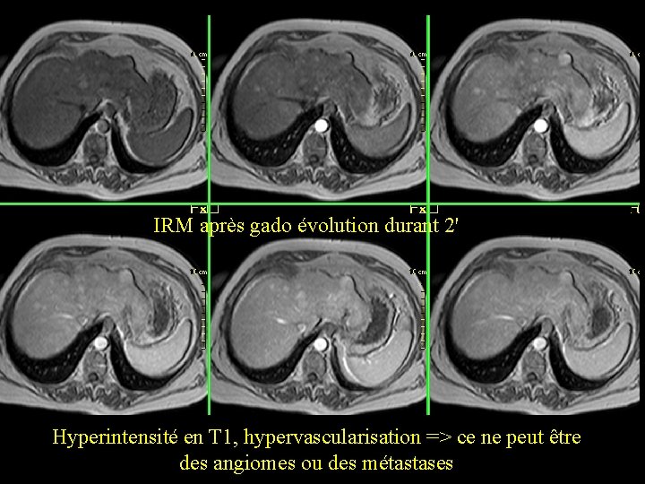 IRM après gado évolution durant 2' Hyperintensité en T 1, hypervascularisation => ce ne