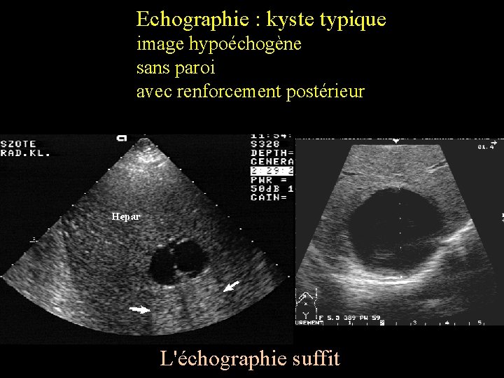 Echographie : kyste typique image hypoéchogène sans paroi avec renforcement postérieur L'échographie suffit 