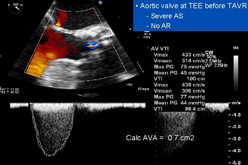  • Aortic valve at TEE before TAVR - Severe AS - No AR