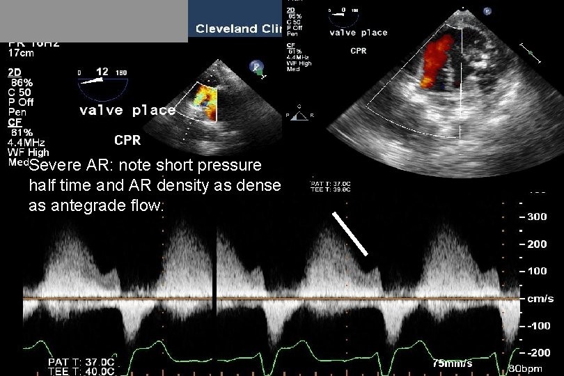 Severe AR: note short pressure half time and AR density as dense as antegrade