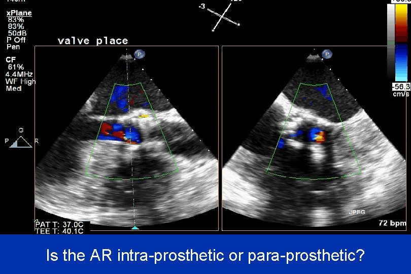 Is the AR intra-prosthetic or para-prosthetic? 