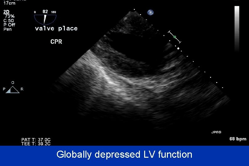 Globally depressed LV function 
