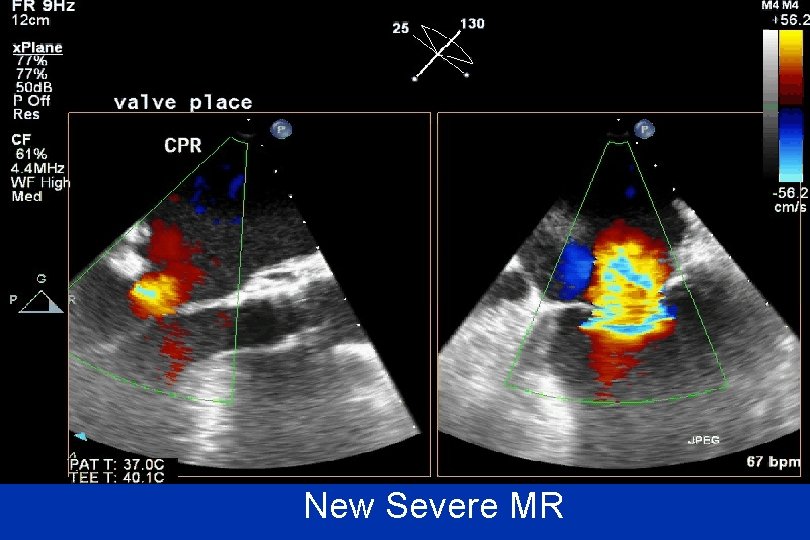 New Severe MR 