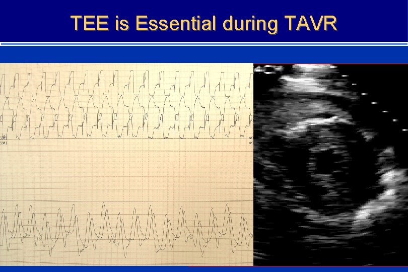 TEE is Essential during TAVR 18 
