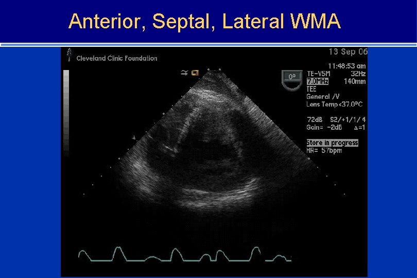 Anterior, Septal, Lateral WMA 