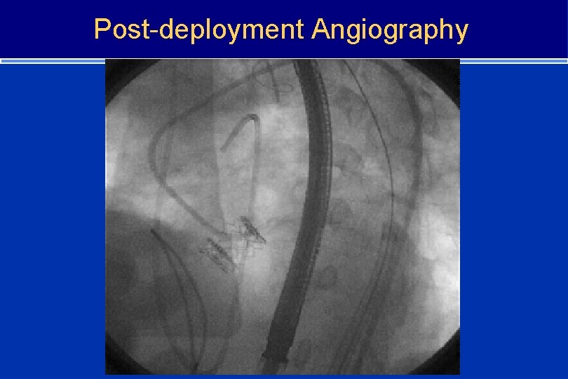 Post-deployment Angiography 