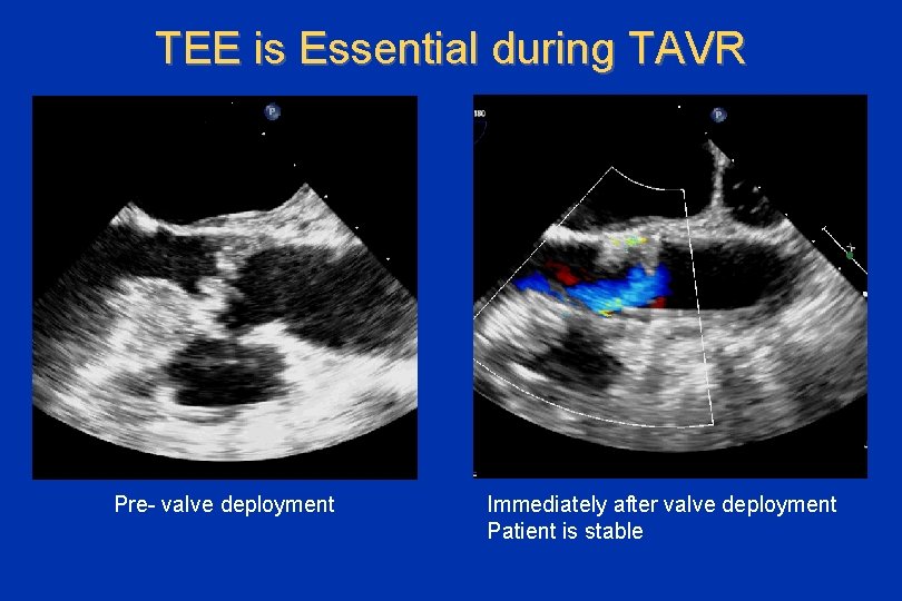 TEE is Essential during TAVR Pre- valve deployment Immediately after valve deployment Patient is