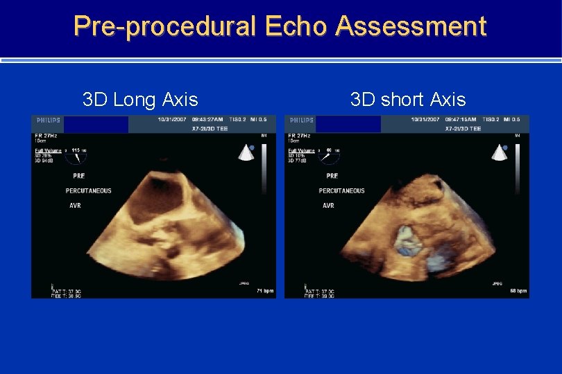 Pre-procedural Echo Assessment 3 D Long Axis 3 D short Axis 