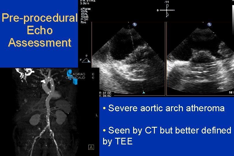 Pre-procedural Echo Assessment • Severe aortic arch atheroma • Seen by CT but better
