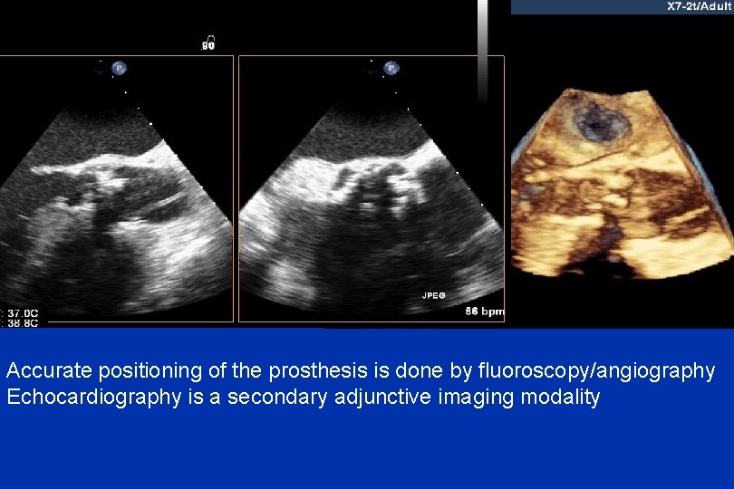 Accurate positioning of the prosthesis is done by fluoroscopy/angiography Echocardiography is a secondary adjunctive