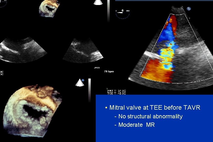 • Mitral valve at TEE before TAVR - No structural abnormality - Moderate