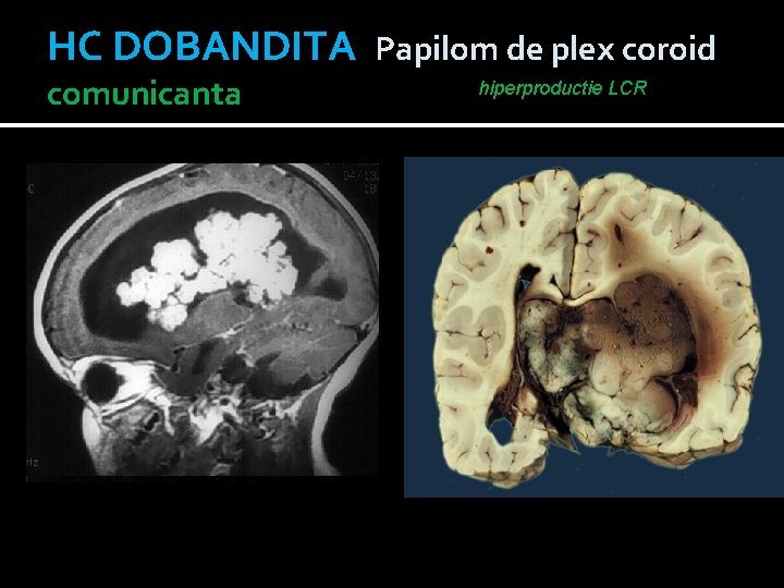 HC DOBANDITA Papilom de plex coroid comunicanta hiperproductie LCR 