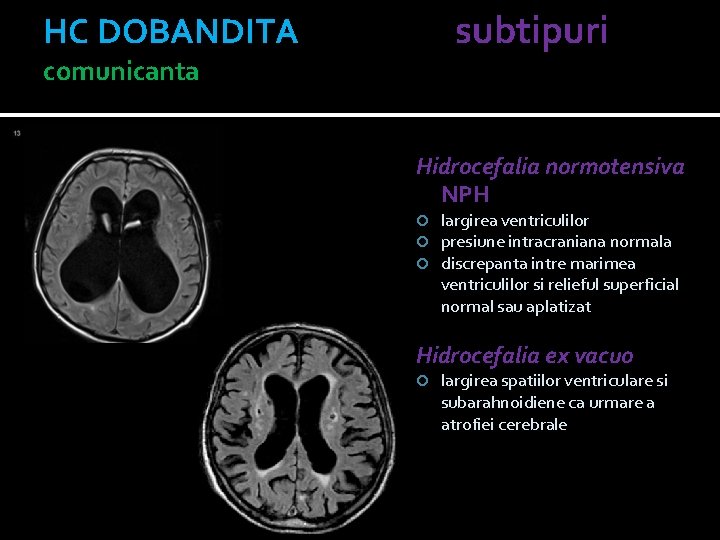 HC DOBANDITA subtipuri comunicanta Hidrocefalia normotensiva NPH largirea ventriculilor presiune intracraniana normala discrepanta intre