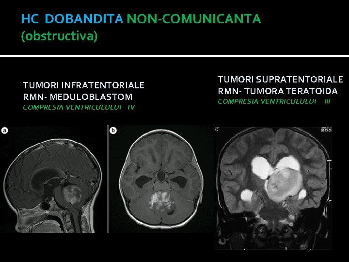 HC DOBANDITA NON-COMUNICANTA (obstructiva) TUMORI INFRATENTORIALE RMN- MEDULOBLASTOM COMPRESIA VENTRICULULUI IV TUMORI SUPRATENTORIALE RMN-