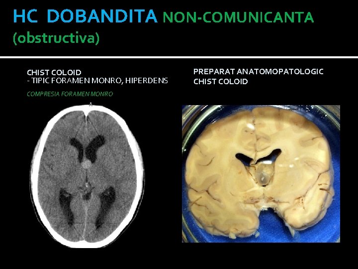 HC DOBANDITA NON-COMUNICANTA (obstructiva) CHIST COLOID - TIPIC FORAMEN MONRO, HIPERDENS PE CT COMPRESIA