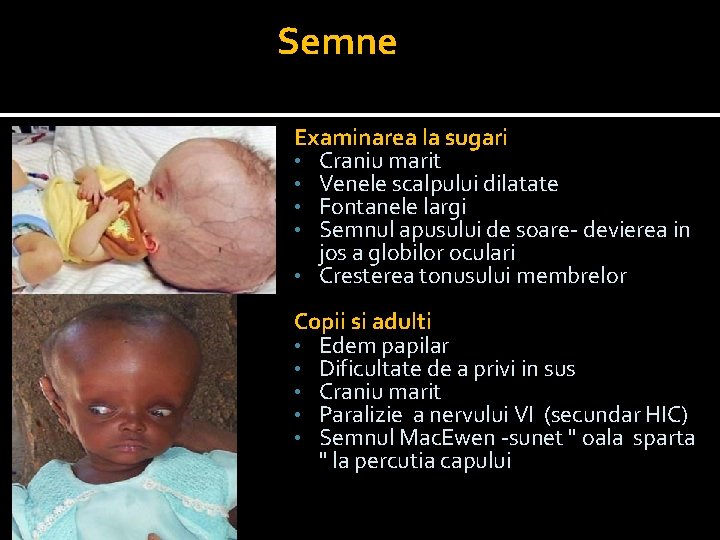 Semne Examinarea la sugari • Craniu marit • Venele scalpului dilatate • Fontanele largi