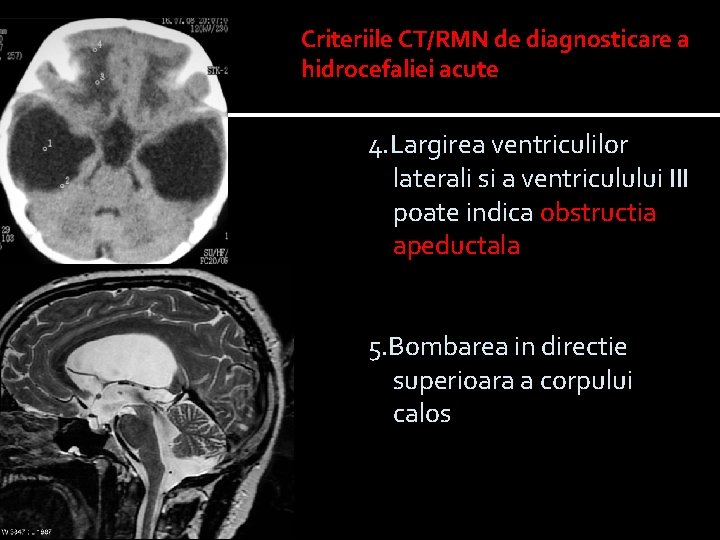 Criteriile CT/RMN de diagnosticare a hidrocefaliei acute 4. Largirea ventriculilor laterali si a ventriculului