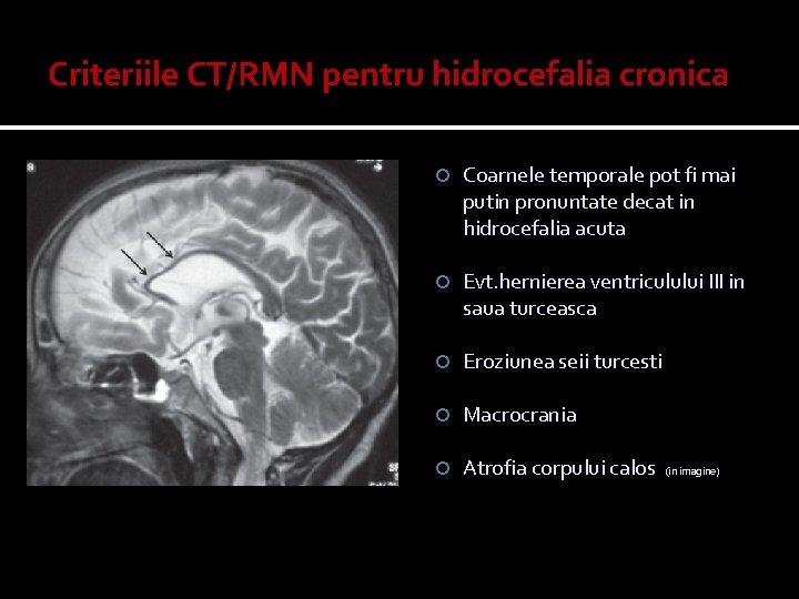 Criteriile CT/RMN pentru hidrocefalia cronica Coarnele temporale pot fi mai putin pronuntate decat in