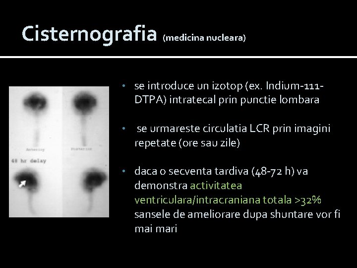 Cisternografia (medicina nucleara) • se introduce un izotop (ex. Indium-111 DTPA) intratecal prin punctie