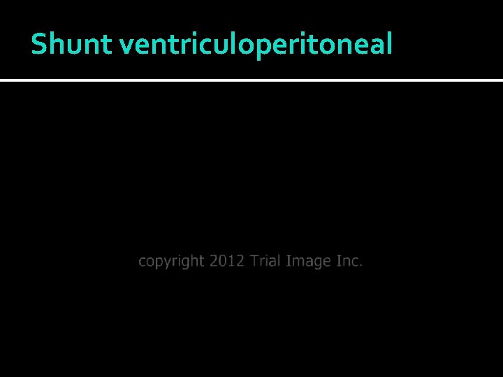 Shunt ventriculoperitoneal 