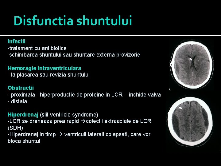 Disfunctia shuntului Infectii -tratament cu antibiotice schimbarea shuntului sau shuntare externa provizorie Hemoragie intraventriculara