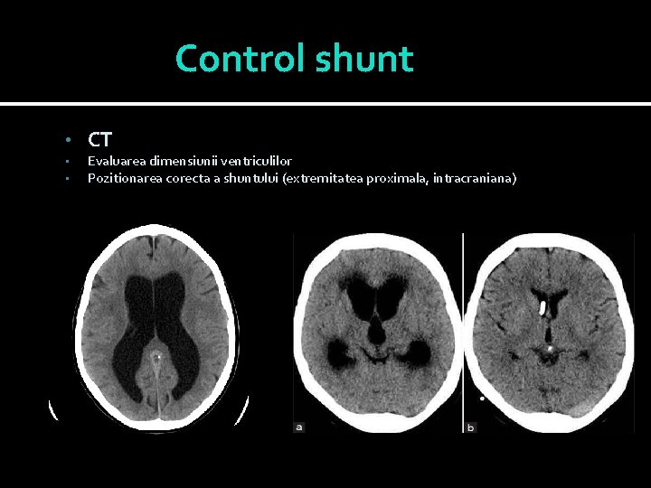 Control shunt • • • CT Evaluarea dimensiunii ventriculilor Pozitionarea corecta a shuntului (extremitatea