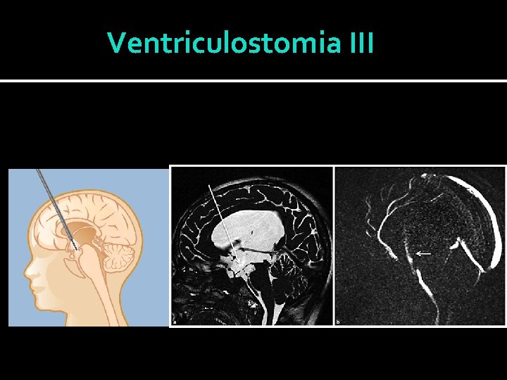 Ventriculostomia III 