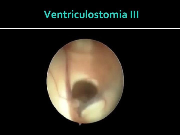 Ventriculostomia III 