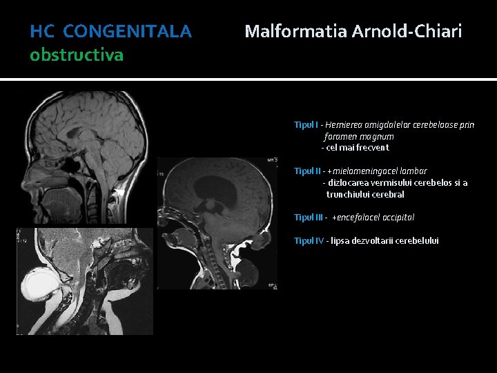 HC CONGENITALA Malformatia Arnold-Chiari obstructiva Tipul I - Hernierea amigdalelor cerebeloase prin foramen magnum