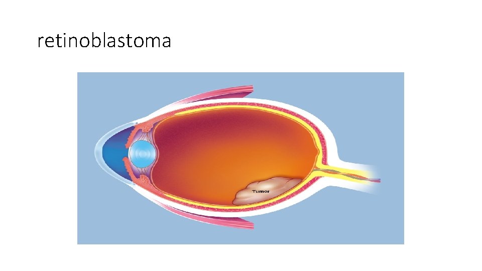 retinoblastoma 