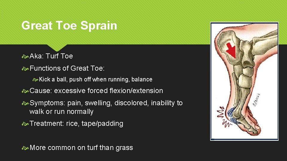 Great Toe Sprain Aka: Turf Toe Functions of Great Toe: Kick a ball, push
