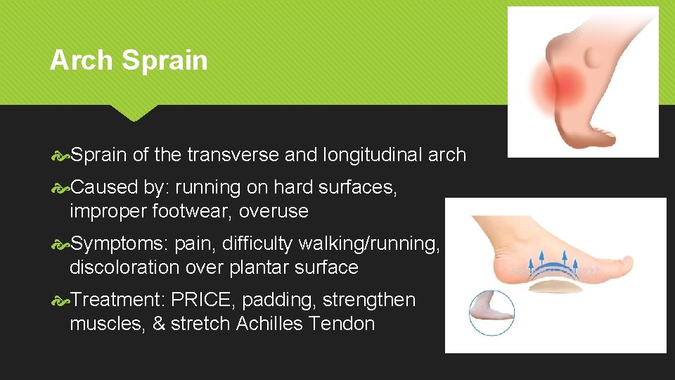 Arch Sprain of the transverse and longitudinal arch Caused by: running on hard surfaces,