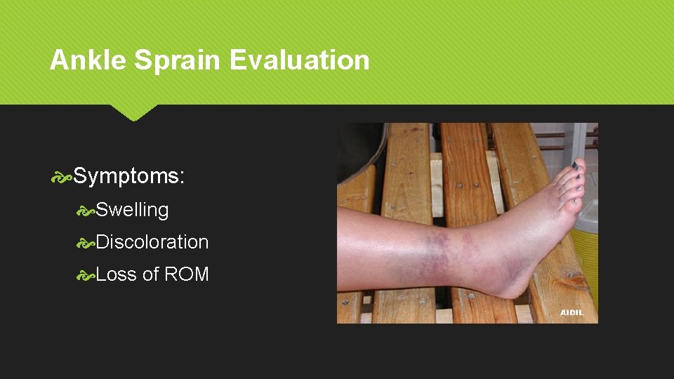 Ankle Sprain Evaluation Symptoms: Swelling Discoloration Loss of ROM 