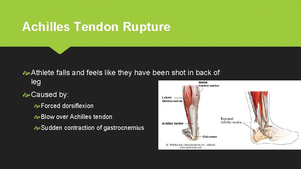 Achilles Tendon Rupture Athlete falls and feels like they have been shot in back