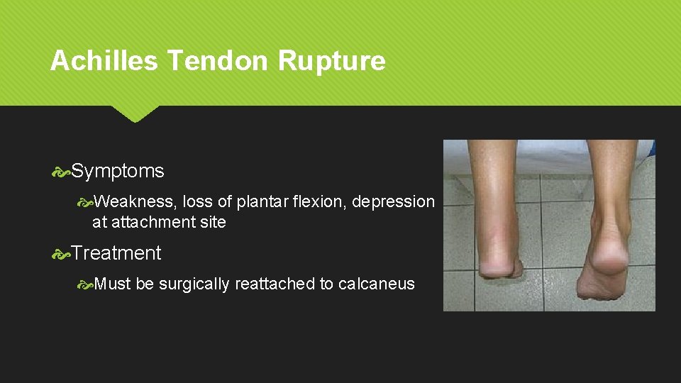 Achilles Tendon Rupture Symptoms Weakness, loss of plantar flexion, depression at attachment site Treatment