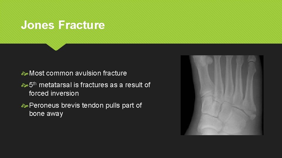 Jones Fracture Most common avulsion fracture 5 th metatarsal is fractures as a result