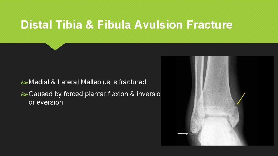 Distal Tibia & Fibula Avulsion Fracture Medial & Lateral Malleolus is fractured Caused by