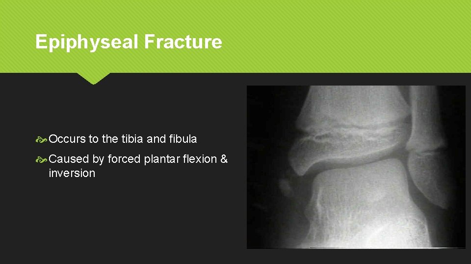 Epiphyseal Fracture Occurs to the tibia and fibula Caused by forced plantar flexion &